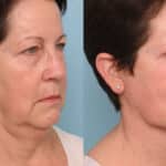 Deep plane facelift before and after showing a more defined jawline, smoother neck and natural facial rejuvenation.