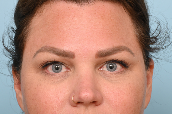 Eye Rejuvenation