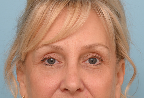 Eye Rejuvenation