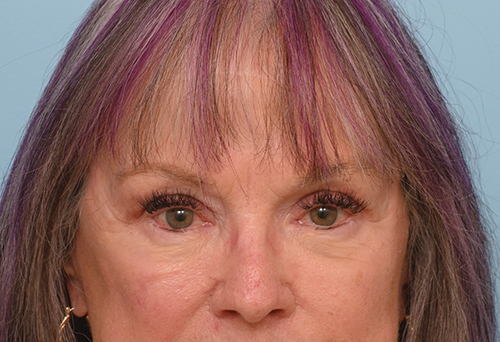 Eye Rejuvenation
