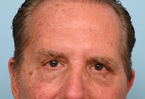 Eye Rejuvenation