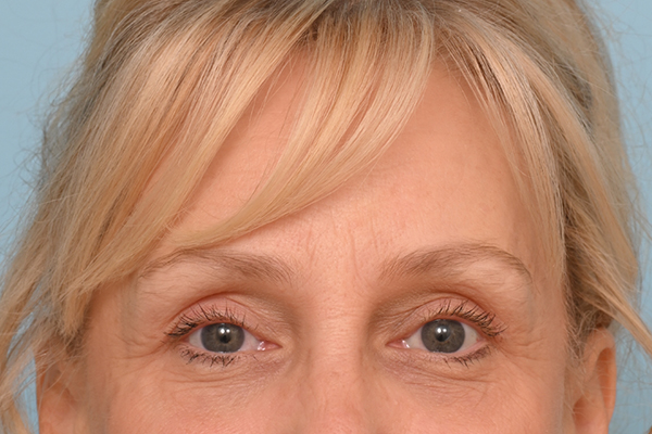 Brow Lift