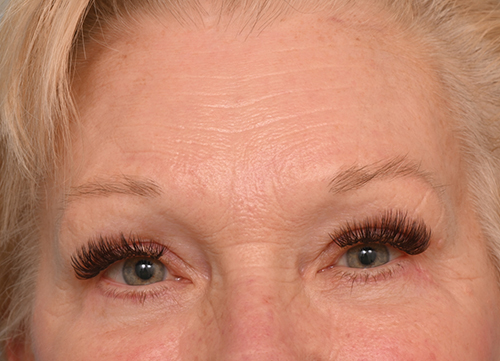 Brow Lift