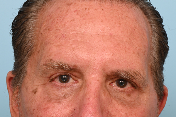 Brow Lift