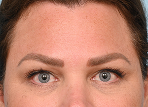 Brow Lift
