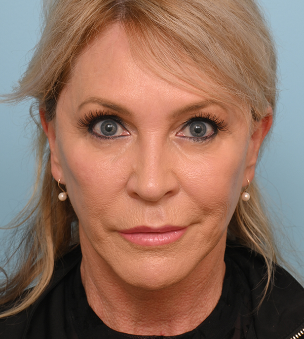 Face Lift/Neck Lift