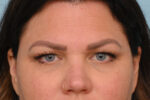 Eye Rejuvenation