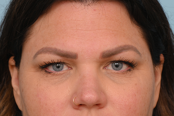 Eye Rejuvenation