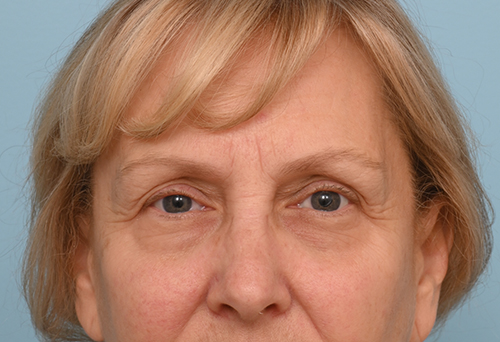 Eye Rejuvenation