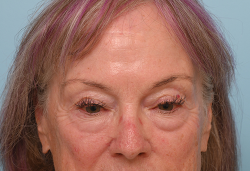 Eye Rejuvenation
