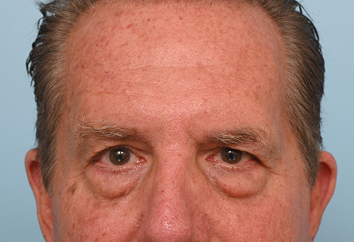 Eye Rejuvenation