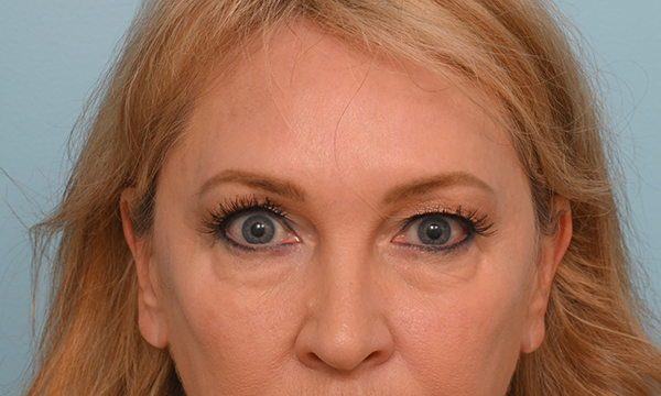 Eye Rejuvenation