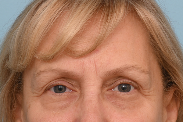 Brow Lift