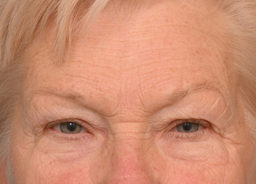 Brow Lift