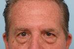 Brow Lift