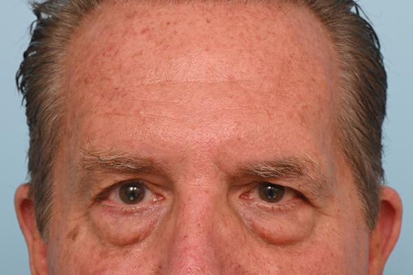 Brow Lift
