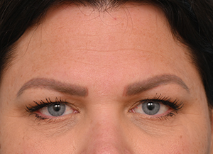 Brow Lift