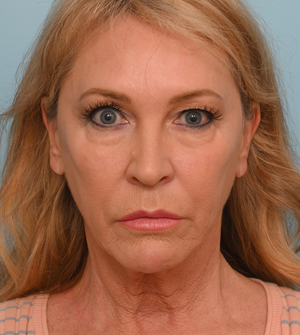 Face Lift/Neck Lift