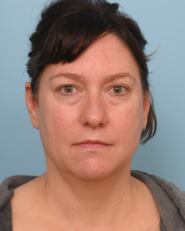 Facial Fat Transfer