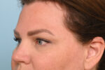 Eye Rejuvenation