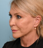 Face Lift/Neck Lift