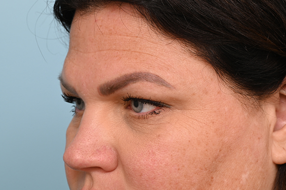 Eye Rejuvenation