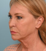 Face Lift/Neck Lift