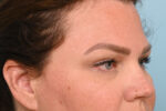Eye Rejuvenation