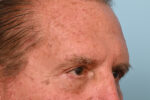 Brow Lift