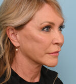Face Lift/Neck Lift