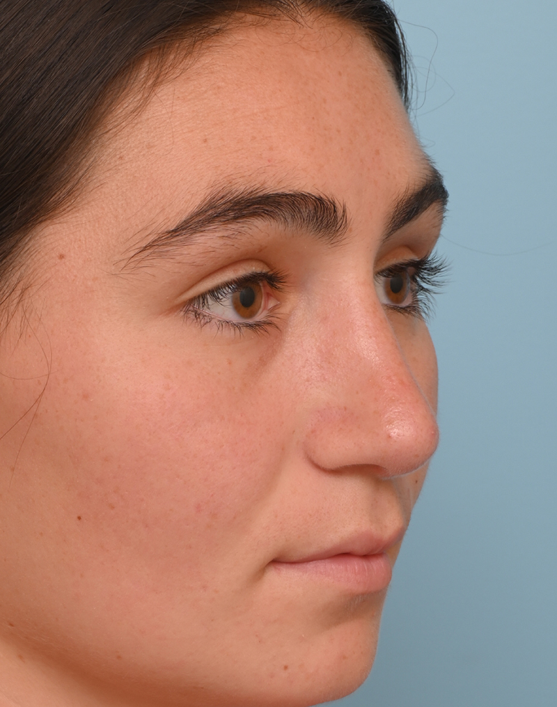 Rhinoplasty