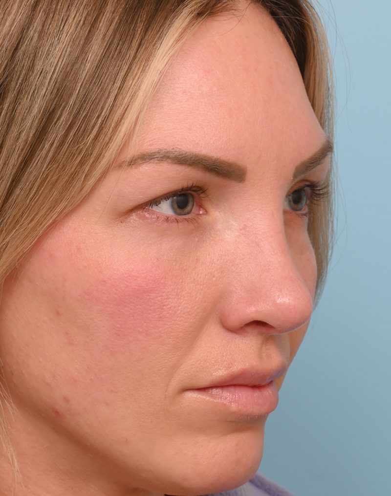 Rhinoplasty