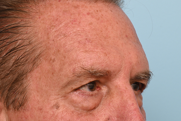 Brow Lift