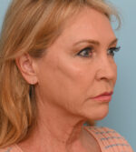 Face Lift/Neck Lift