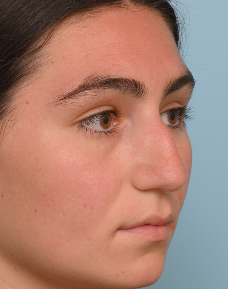 Rhinoplasty