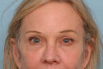 Eye Rejuvenation