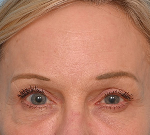 Brow Lift