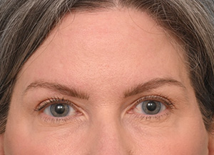 Brow Lift
