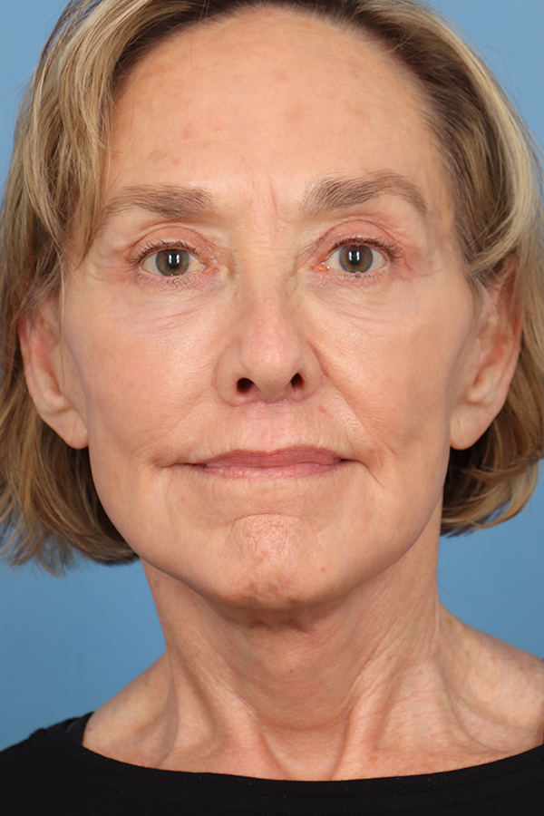Face Lift/Neck Lift