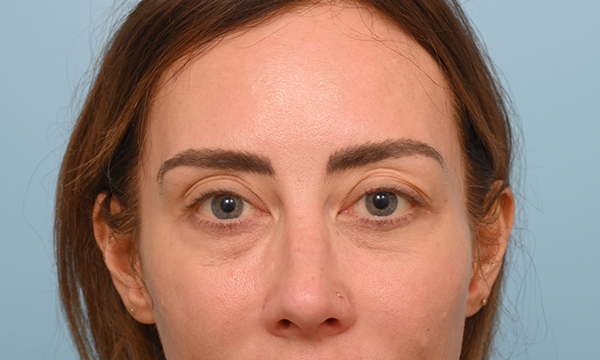 Facial Fat Transfer