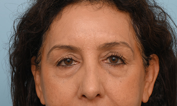 Eye Rejuvenation