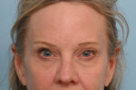 Eye Rejuvenation