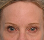 Brow Lift