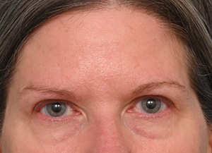 Brow Lift