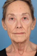 Face Lift/Neck Lift