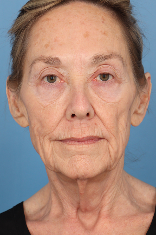 Face Lift/Neck Lift