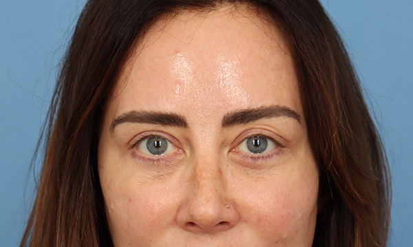 Facial Fat Transfer