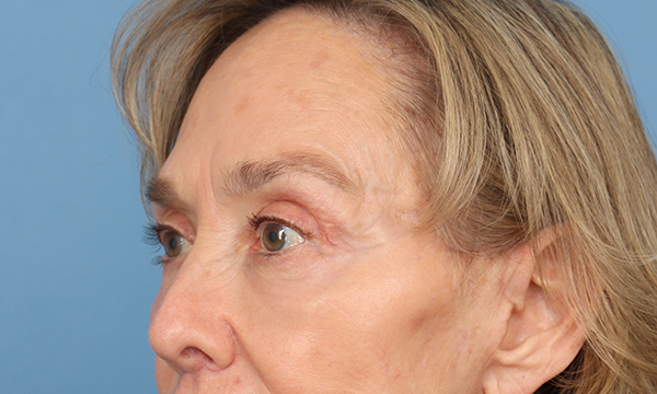 Eye Rejuvenation
