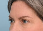Brow Lift