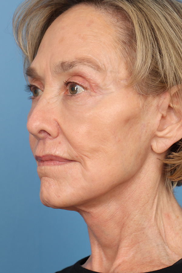Face Lift/Neck Lift
